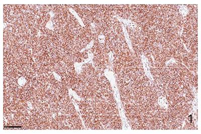 Immune checkpoint inhibitors targeting PD-1/PD-L1 in the treatment of human lymphomas